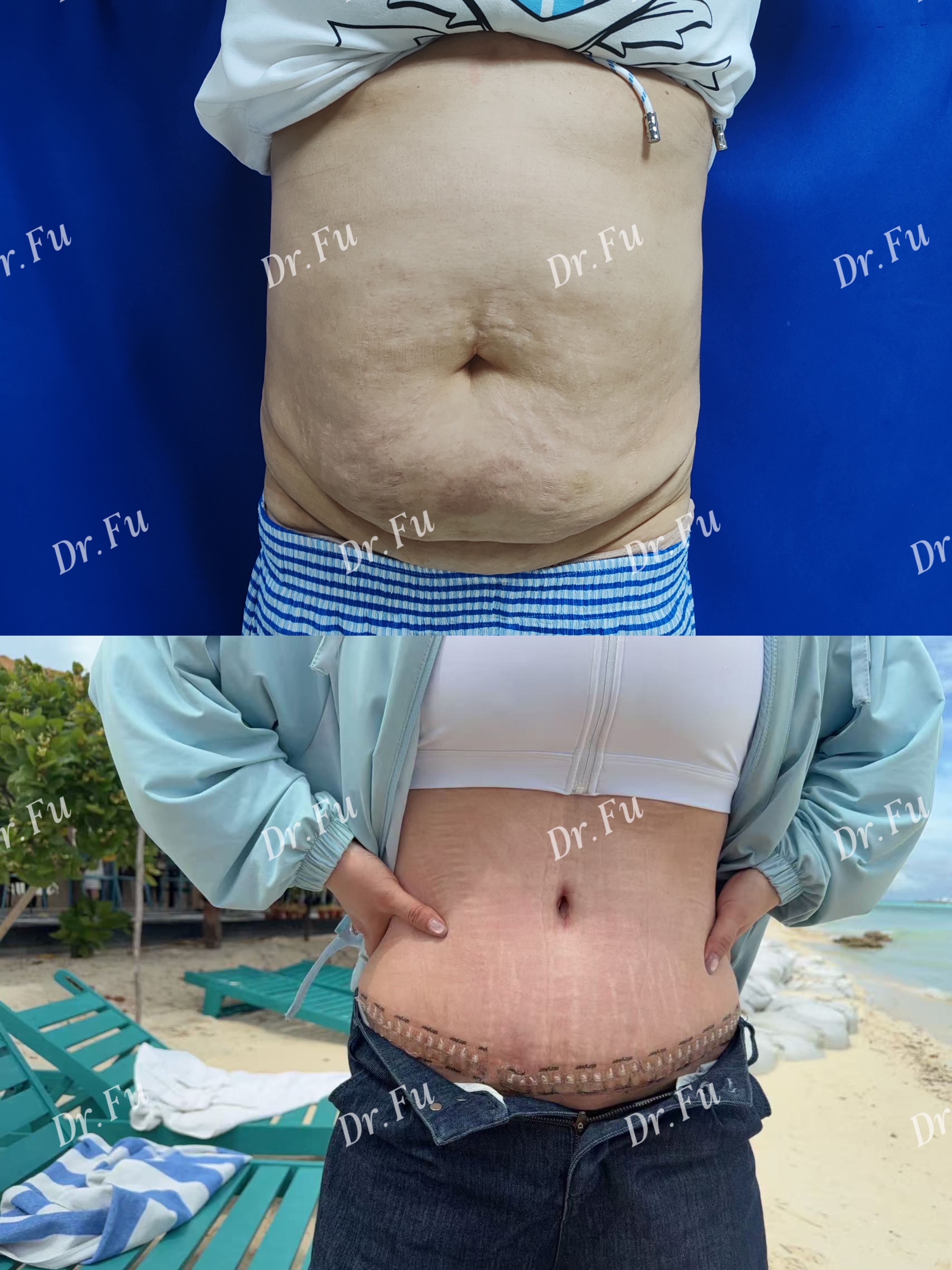 Abdominoplasty Case 1